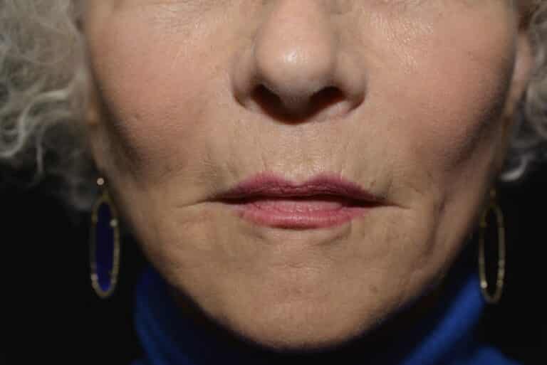 After Image: Lip Lift - front