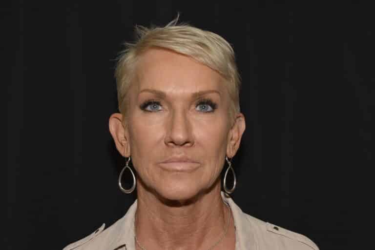 After Image: Lip Lift - front