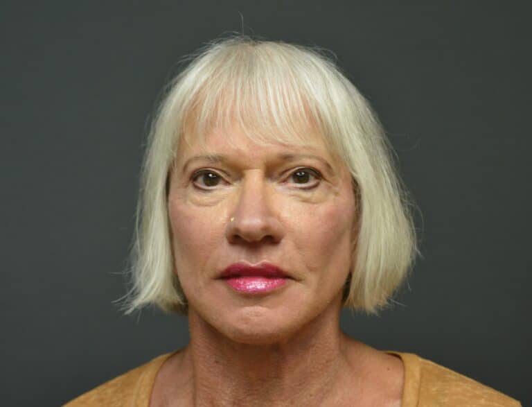 After Image: Naturale Face neck lift - 