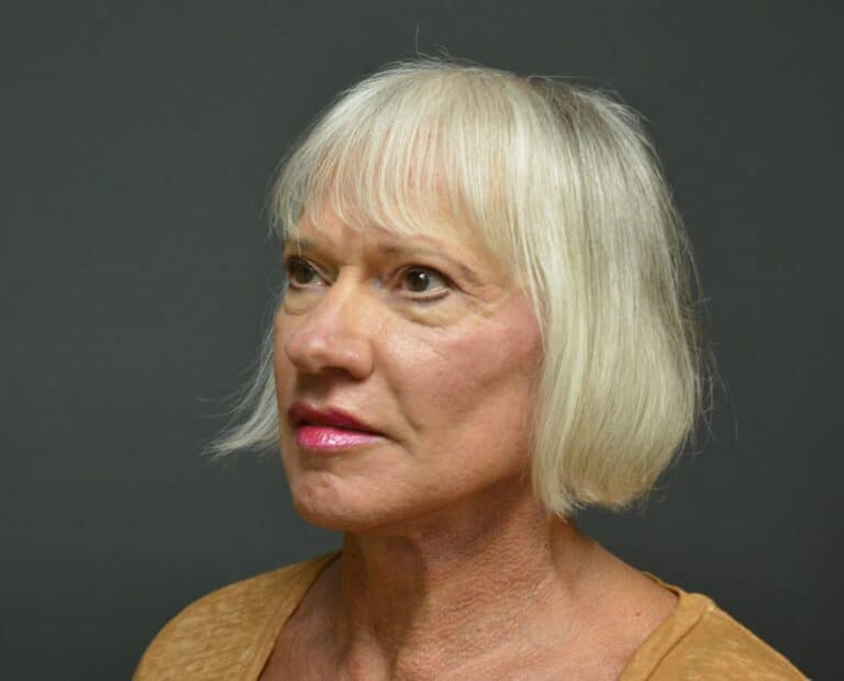 After Image: Naturale Face neck lift - front