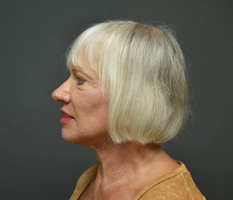 After Image: Naturale Face neck lift - 