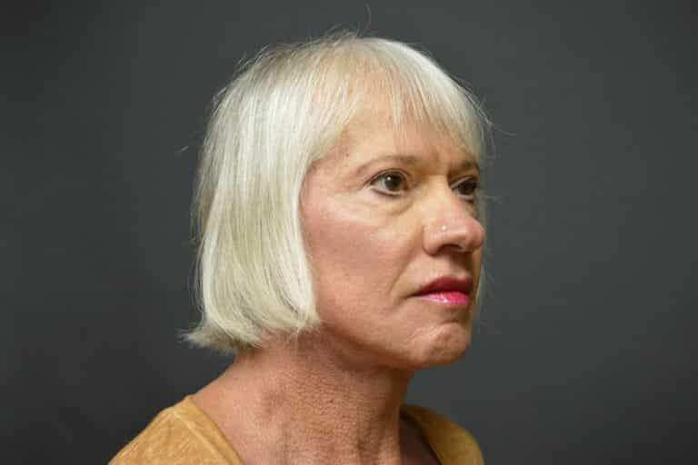 After Image: Naturale Face neck lift - 