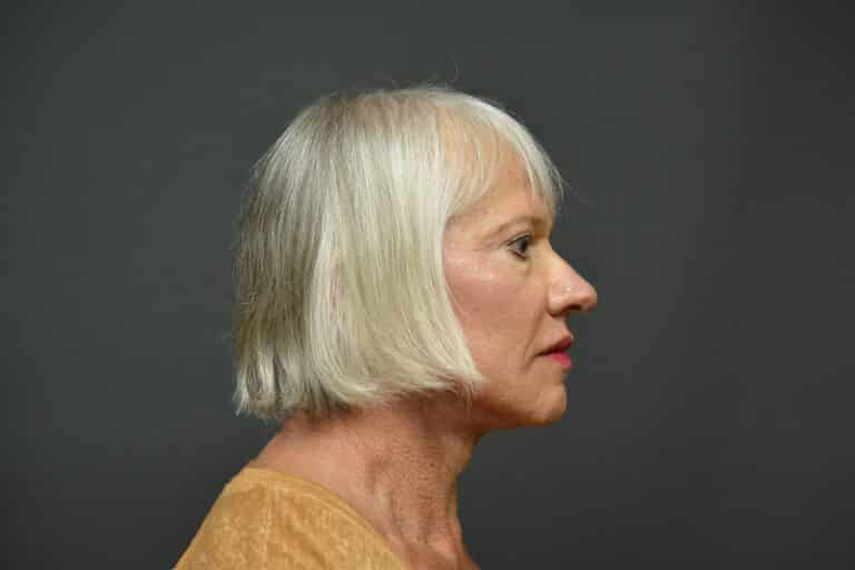 After Image: Naturale Face neck lift - 