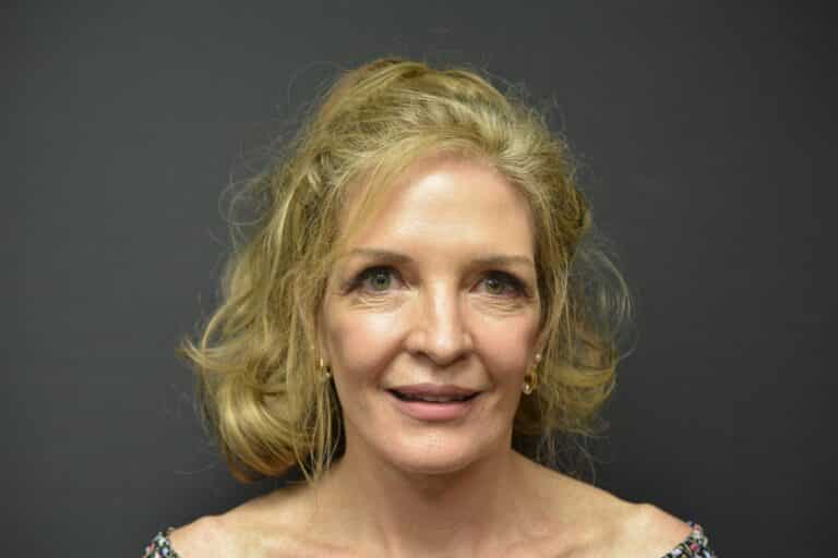 After Image: Naturale Face-Neck lift - front
