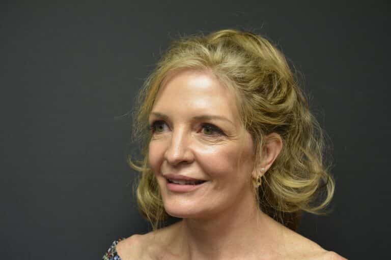 After Image: Naturale Face-Neck lift - 