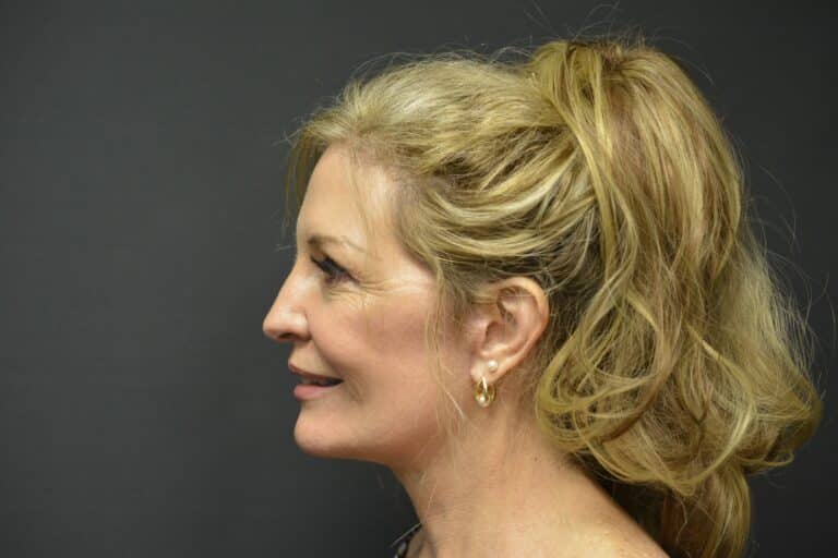 After Image: Naturale Face-Neck lift - 
