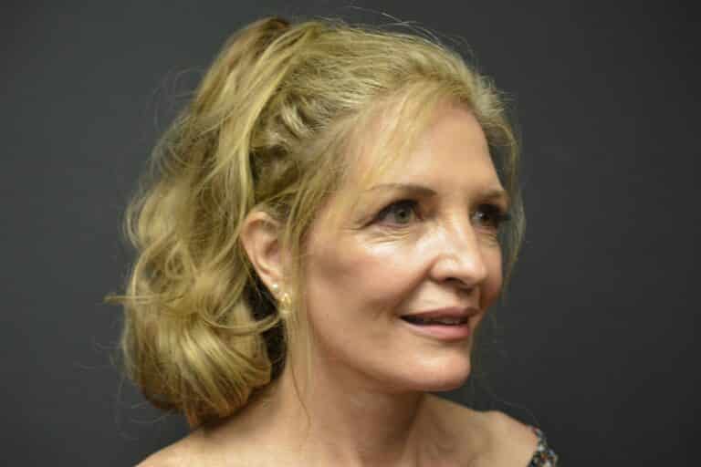 After Image: Naturale Face-Neck lift - 