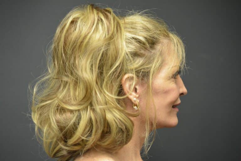 After Image: Naturale Face-Neck lift - 
