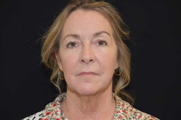 Before Image: Naturale Face Neck lift - 