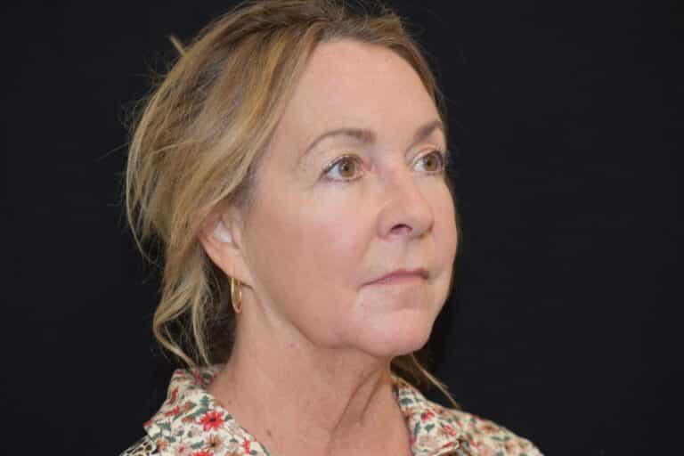 Before Image: Naturale Face Neck lift - 