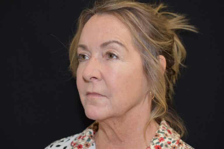 Before Image: Naturale Face Neck lift - 