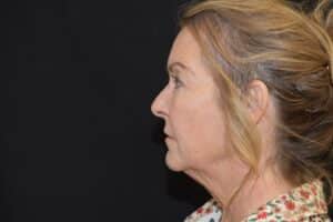 Before Image: Naturale Face Neck lift