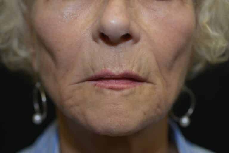 Before Image: Lip Lift - front