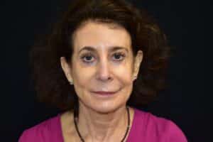 Before Image: Lip Lift