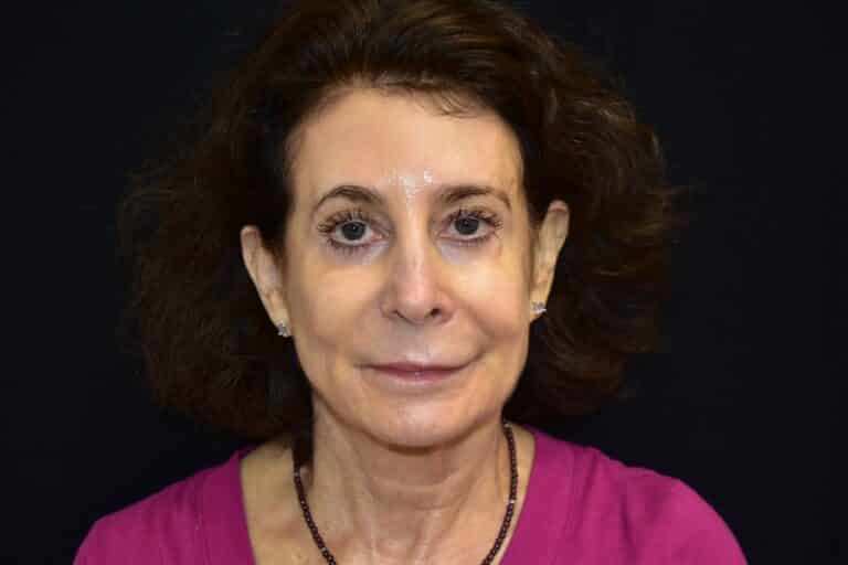 Before Image: Lip Lift - front