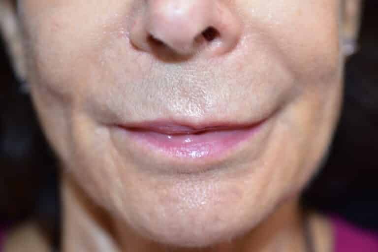 Before Image: Lip Lift - 