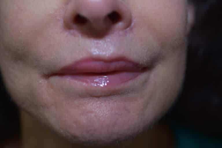 After Image: Lip Lift - 