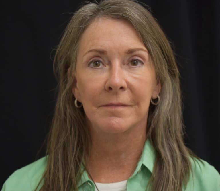After Image: Naturale Face Neck lift - 