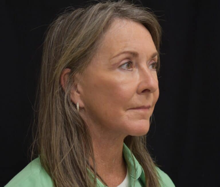 After Image: Naturale Face Neck lift - 