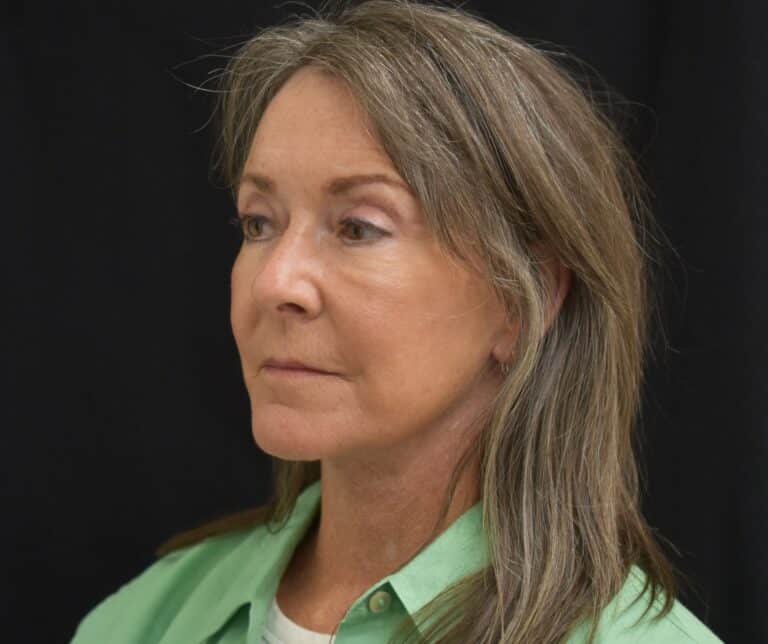 After Image: Naturale Face Neck lift - 