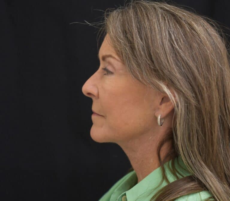 After Image: Naturale Face Neck lift - front