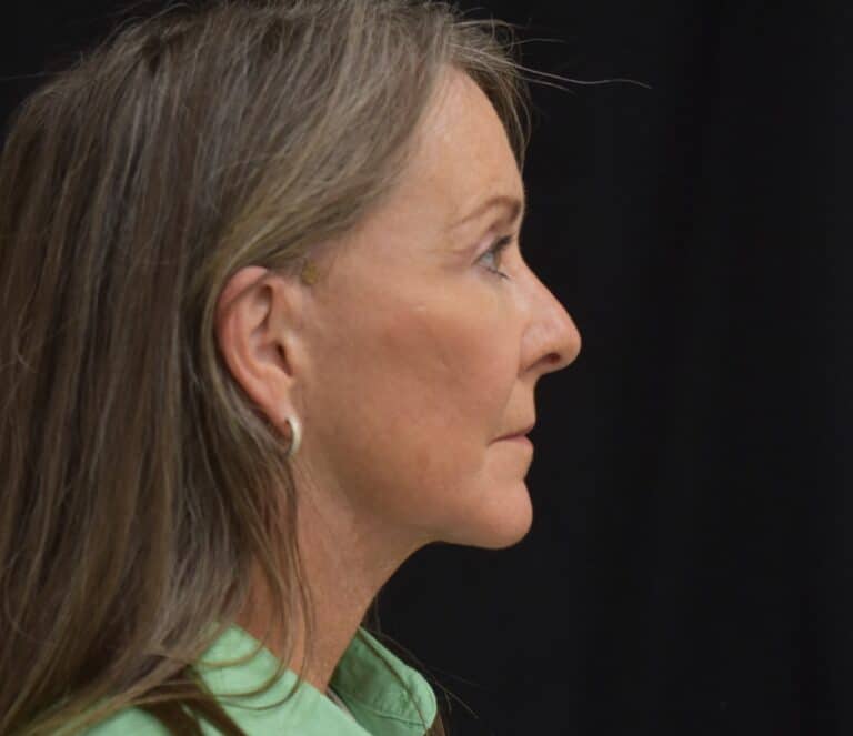 After Image: Naturale Face Neck lift - 
