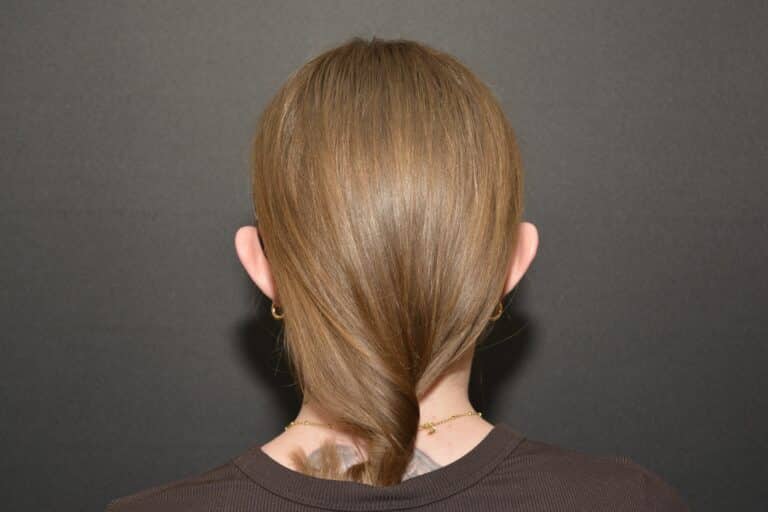 Before Image: Otoplasty - 