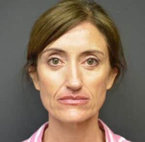 After Image: Lower blepharoplasty