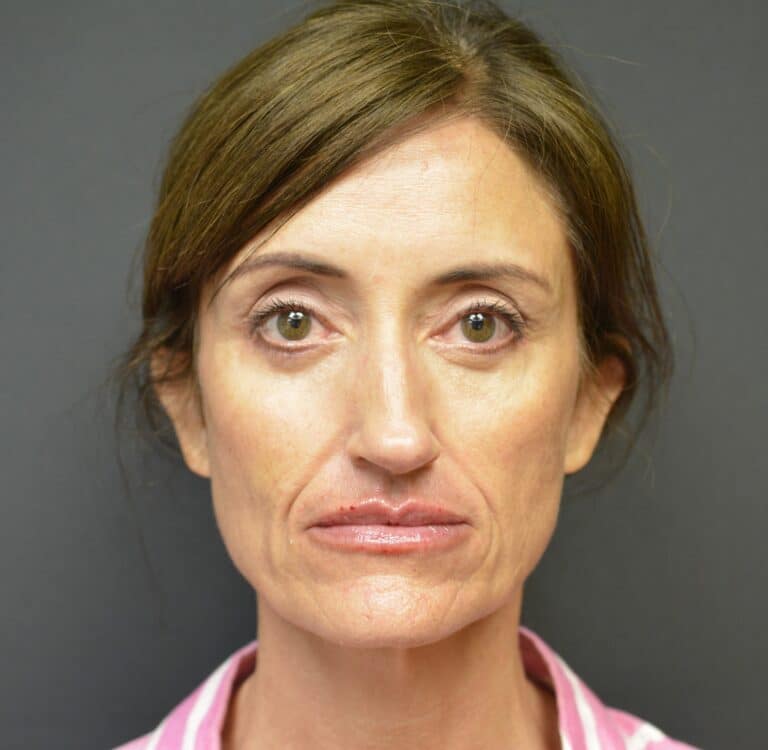 After Image: Lower blepharoplasty - front