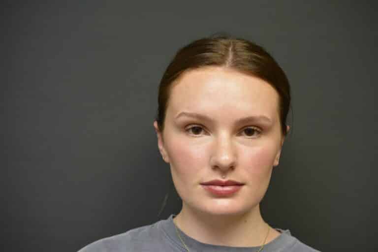 After Image: Otoplasty - front