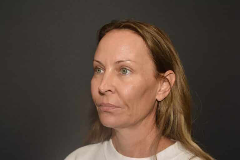 Before Image: Naturale Face neck lift - 