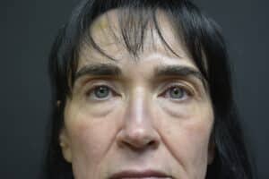 Before Image: Upper and Lower Eyelid Surgery