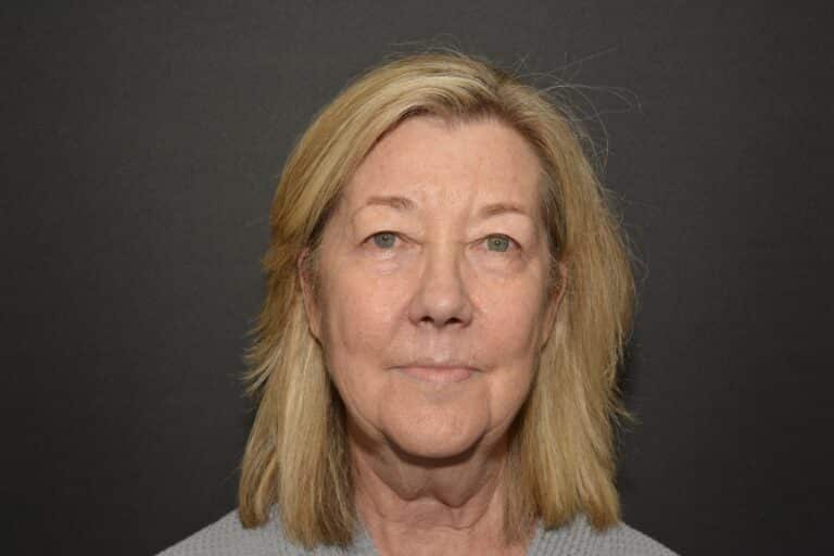 Before Image: Naturale Face Neck Lift - 