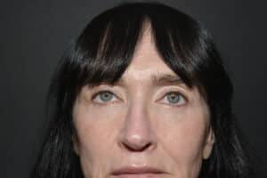 After Image: Upper and Lower Eyelid Surgery