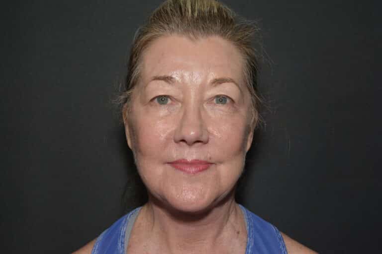 After Image: Naturale Face Neck Lift - 