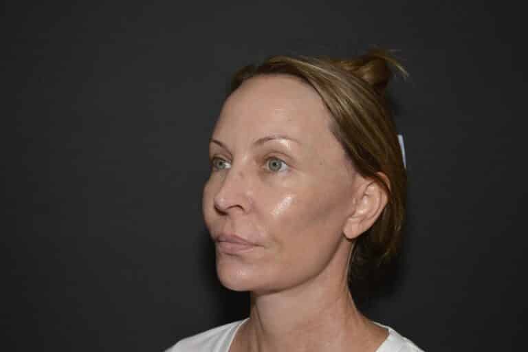 After Image: Naturale Face neck lift - 